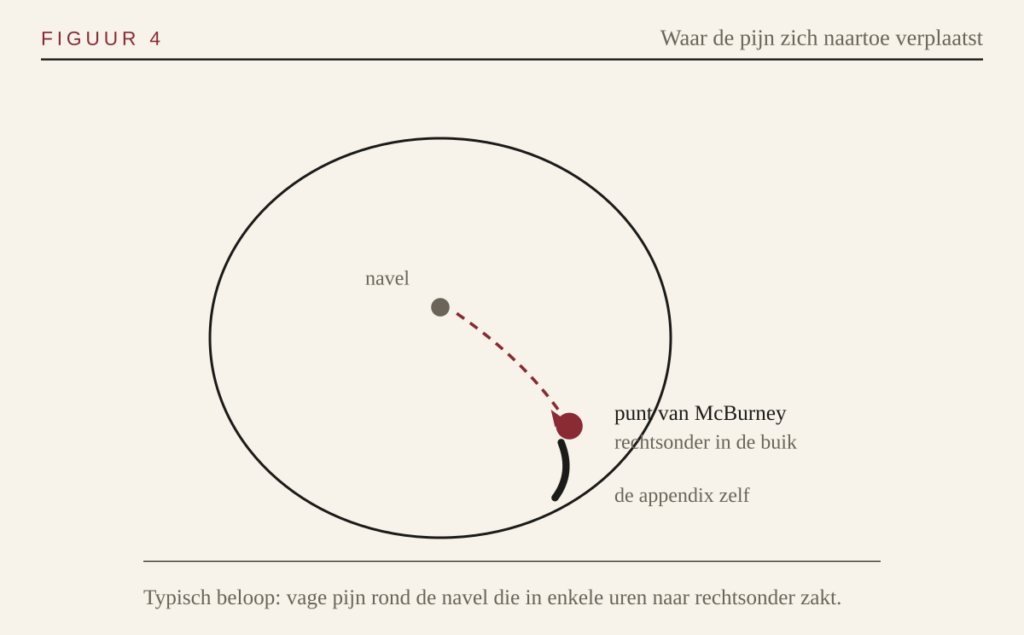 Schema van de verplaatsing van de pijn naar de punt van McBurney