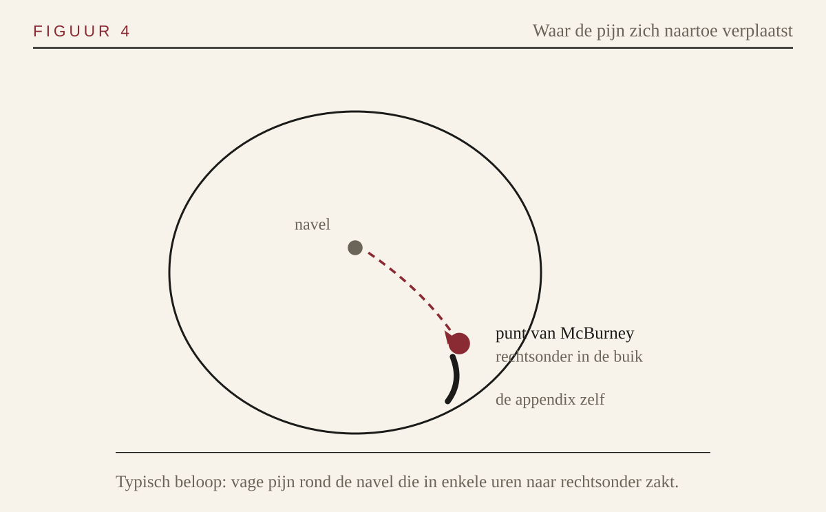 Schema van de buik met de verplaatsing van de pijn naar de punt van McBurney