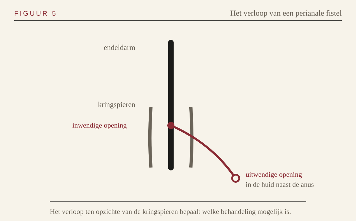Schema van het verloop van een perianale fistel ten opzichte van de kringspieren