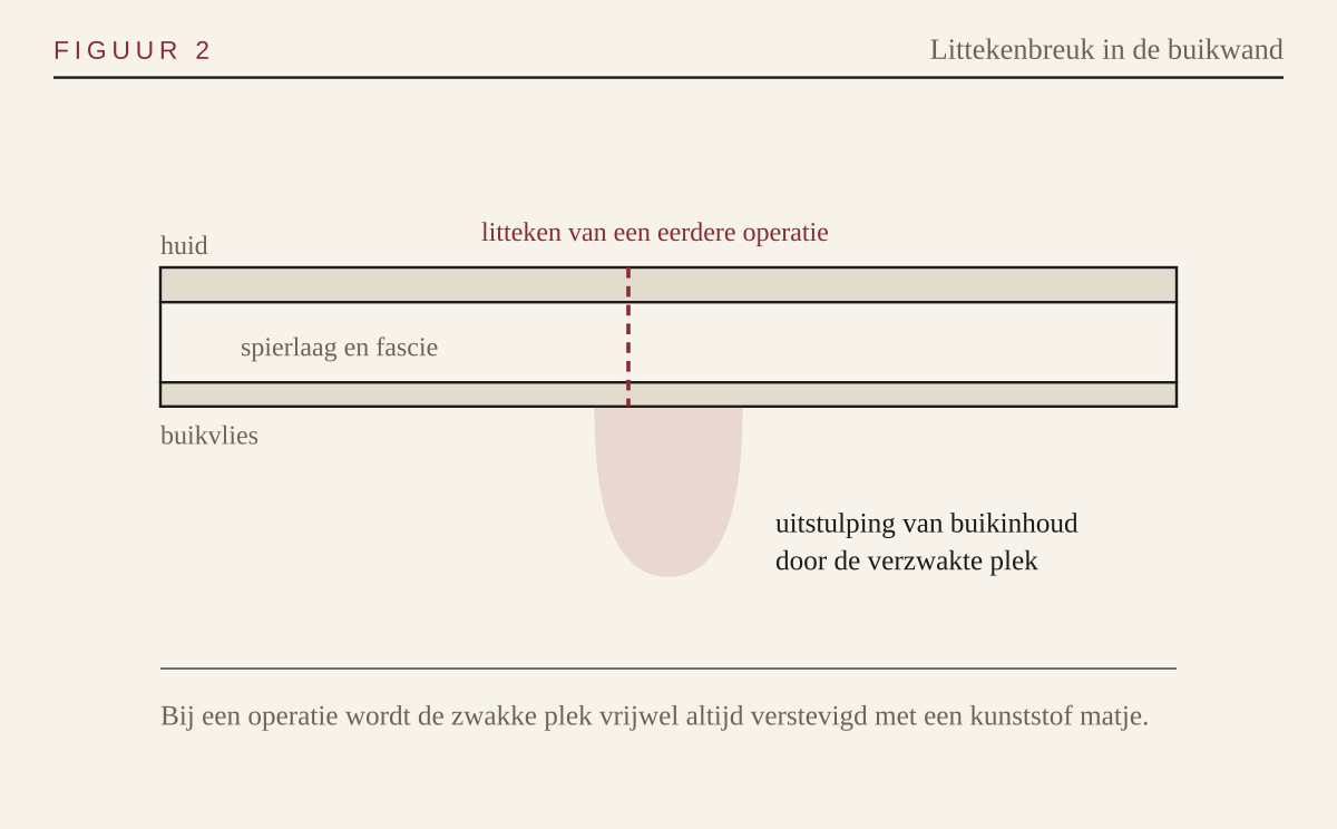 Doorsnede van de buikwand met een littekenbreuk ter hoogte van het litteken